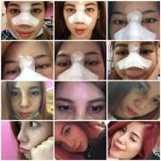 Nhật ký nâng mũi của hot beauty blogger Changmakeup