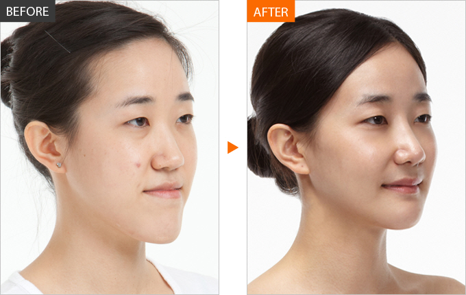 Nâng mũi Hàn Quốc giúp bạn loại bỏ chiếc mũi to, bè, thấp