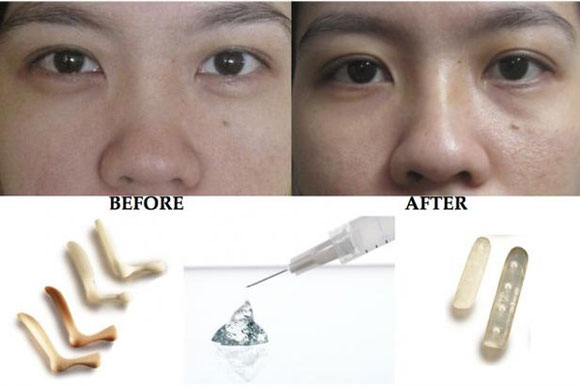 Sụn tự thân có khả năng ngăn ngừa các biến chứng sau phẫu thuật
