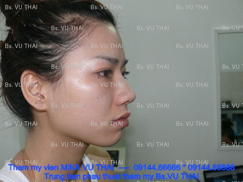 độn cằm cho mặt tròn - 1
