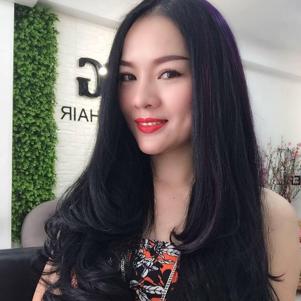 Hình ảnh sau 8 năm phẫu thuật độn cằm Vline