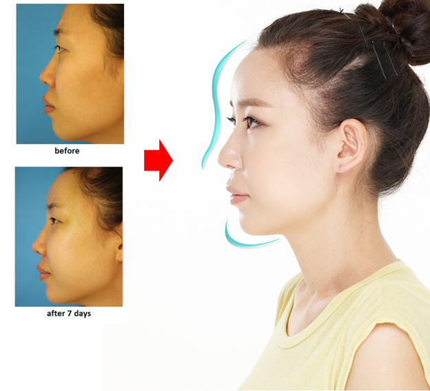 Nâng mũi Sline mang tới cho bạn chiếc mũi hoàn hảo, tự nhiên