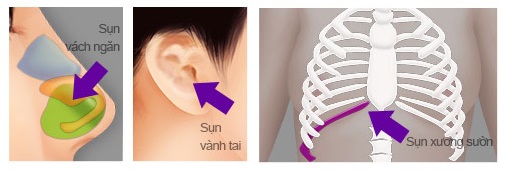 Nâng mũi Sline Hàn Quốc sử dụng sụn tự thân