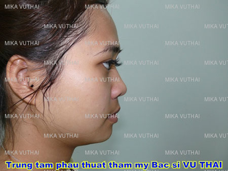nang-mui-boc-sun-gia-bao-nhieu