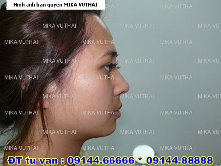 nang-mui-boc-sun-gia-bao-nhieu