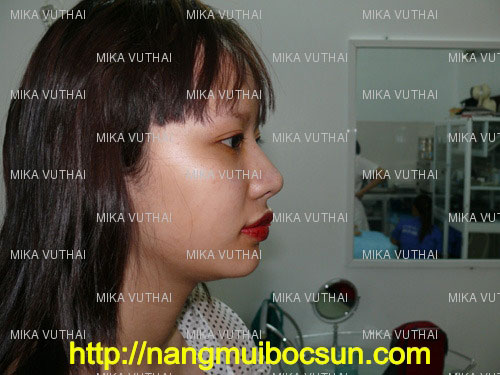 nang-mui-boc-sun-gia-bao-nhieu