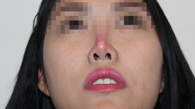 Biến chứng có thể gặp khi nâng mũi tại địa chỉ không an toàn