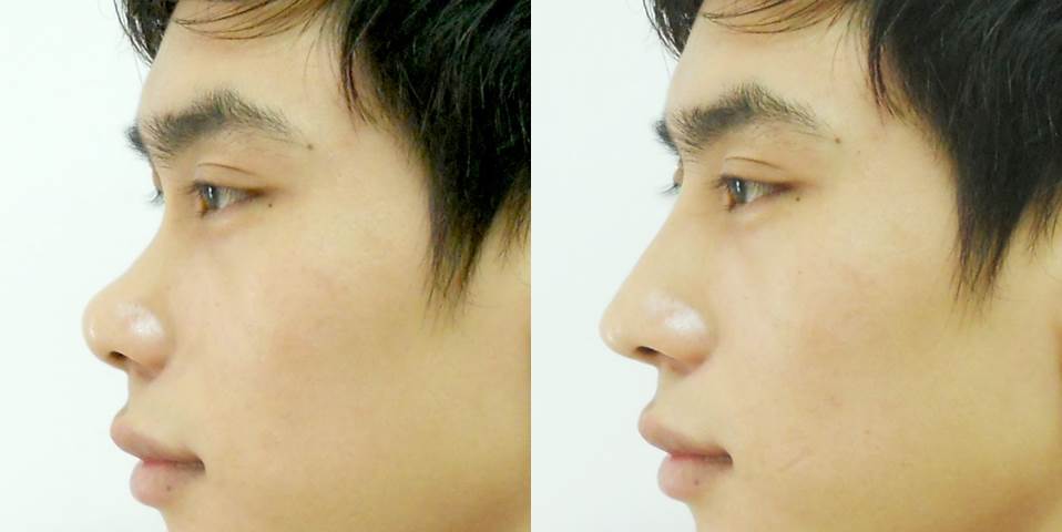 Tỉ lệ nâng mũi Hàn Quốc của nam giới Việt Nam không ngừng tăng