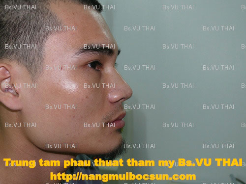 Nam giới nâng mũi Hàn Quốc ngày càng gia tăng