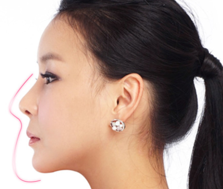 Phẫu thuật nâng mũi Sline mang lại chiếc mũi đẹp hoàn hảo