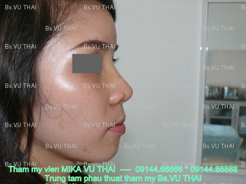 Trước khi phẫu thuật nâng mũi Sline