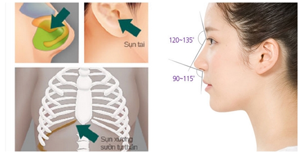Nâng mũi Sline sụn tự thân hoàn toàn sử dụng sụn tự thân 100%
