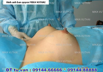 Kết quả sau khi nâng ngực