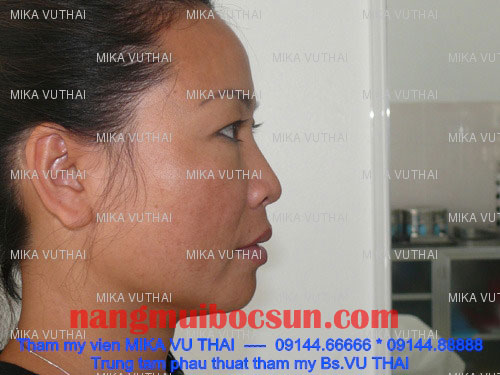 Người phụ nữ 10 năm sau nâng mũi giờ ra sao…