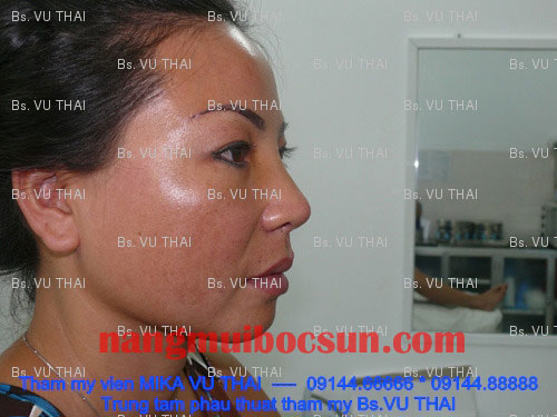 Người phụ nữ 10 năm sau nâng mũi giờ ra sao…