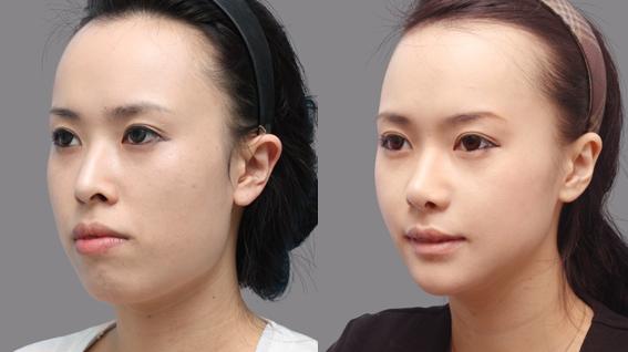 Hàm hô vẩu khiến nhiều người thiếu tự tin