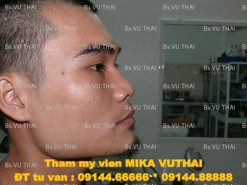 Nâng mũi Sline cho nam thường đòi hỏi độ phức tạp hơn nữ giới