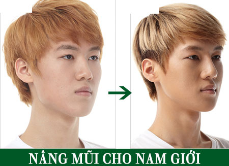 Nâng mũi bọc sụn là một trong những phương pháp nâng mũi phổ biến