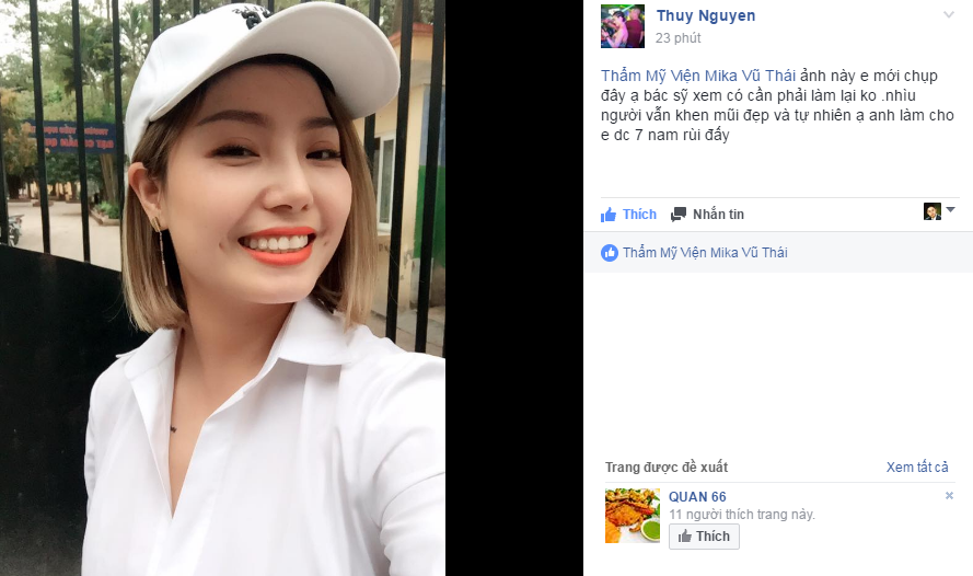 Chia sẻ của Thuy Nguyen sau 7 năm nâng mũi 